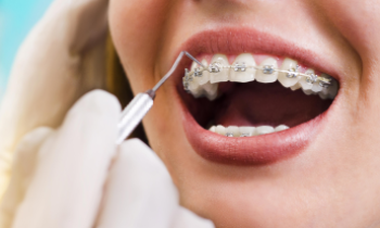 5 Myths About Mouth & Teeth Whitening